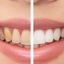 Cost of Teeth Whitening in ... - Picture Box