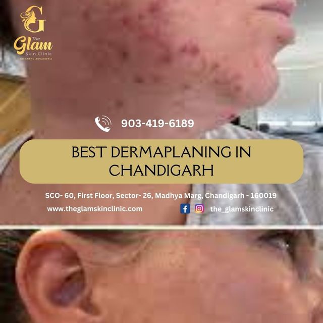Best Dermaplaning in Chandigarh Best Dermaplaning in Chandigarh