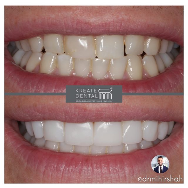 dartford-dental-implants Kreate Dental Dartford