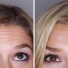 botox-review-before-and-after - Skinoza clinic Orpington