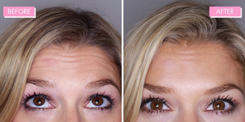 botox-review-before-and-after Skinoza clinic Orpington