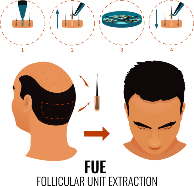 FUE Hair transplant surgery in London, UK FUE Hair transplant surgery in London, UK.