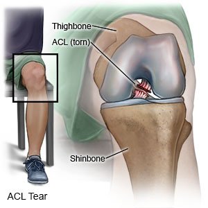 Top-Rated ACL Ligament Surgery in Jaipu Picture Box