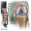 Top-Rated ACL Ligament Surg... - Picture Box