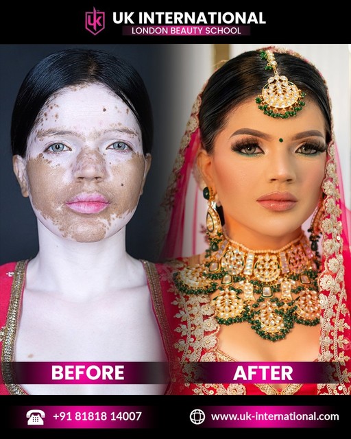 Vitiligo skin makeup At UK International  UK International