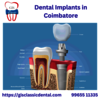 Dental Implants in Coimbato... - GIS Classic