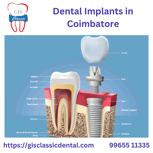 Dental Implants in Coimbatore | Implant Dentistry  GIS Classic