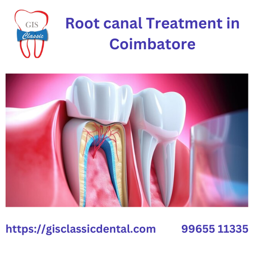 Root Canal Treatment in Coimbatore | Endodontist i GIS Classic