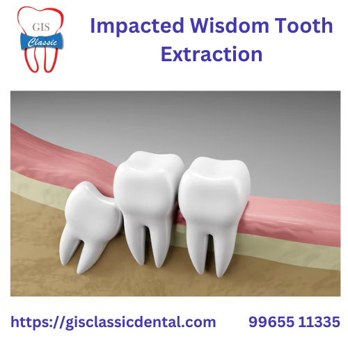 Impacted Wisdom Tooth Extraction | Wisdom Tooth Su GIS Classic