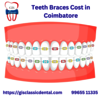 Teeth Braces Cost in Coimba... - GIS Classic