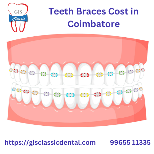 Teeth Braces Cost in Coimbatore | Affordable Brace GIS Classic