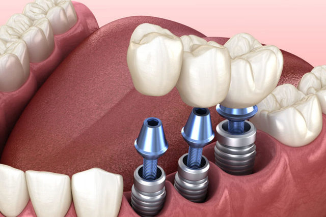 dental-implants-800x534 Pic