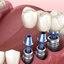 dental-implants-800x534 - Pic