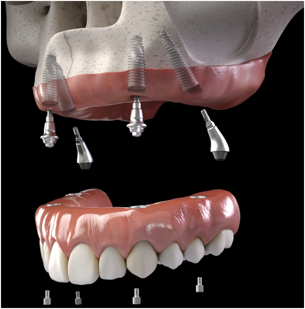 all-on-four-fixed-permanent-dental-implants Pic