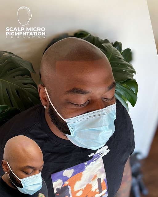 c1 SCALPMICRO Scalp Micropigmentation Calgary