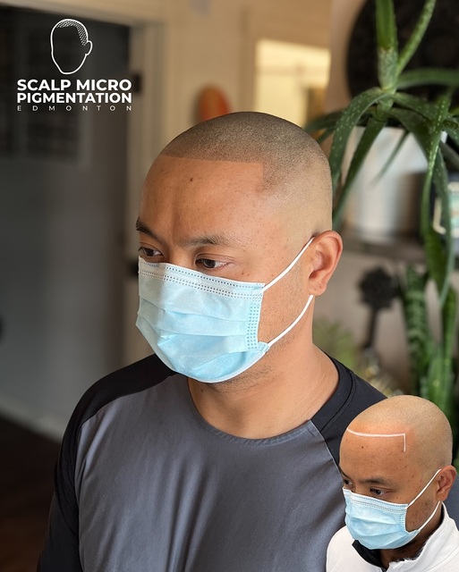 c2 SCALPMICRO Scalp Micropigmentation Calgary