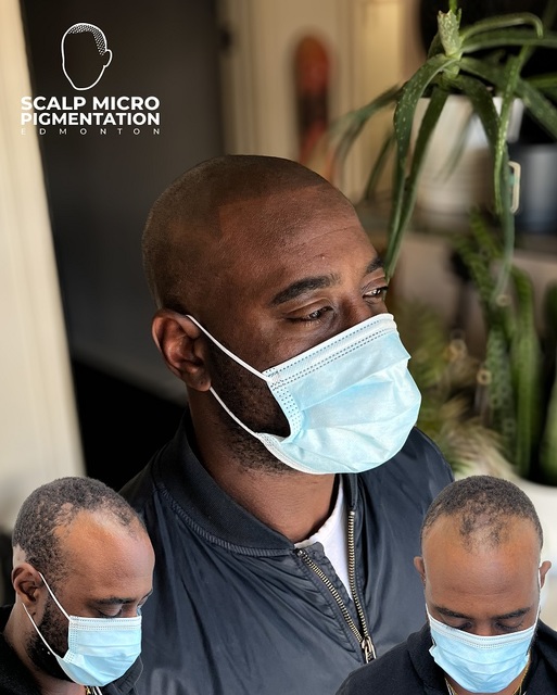 c3 SCALPMICRO Scalp Micropigmentation Calgary