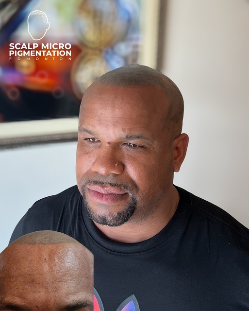 c4 SCALPMICRO Scalp Micropigmentation Calgary