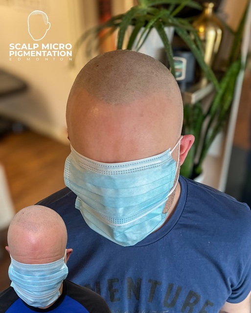 c5 SCALPMICRO Scalp Micropigmentation Calgary