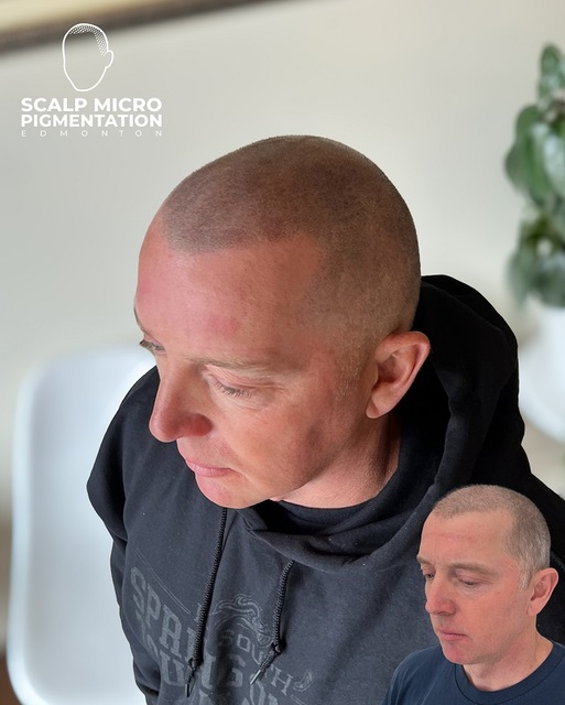 c6 SCALPMICRO Scalp Micropigmentation Calgary