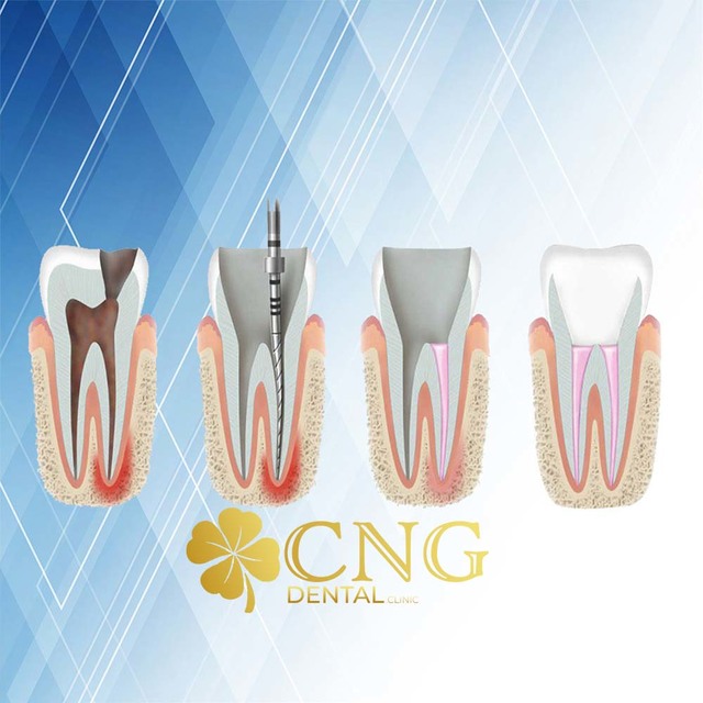 MuÄŸla Kanal Tedavisi CNG DENTAL