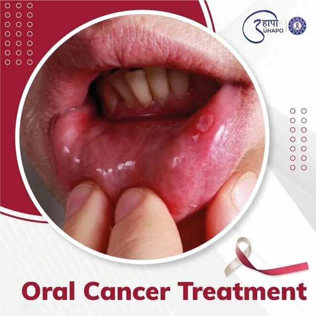 Oral Cancer Treatment Picture Box