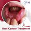 Oral Cancer Treatment - Picture Box