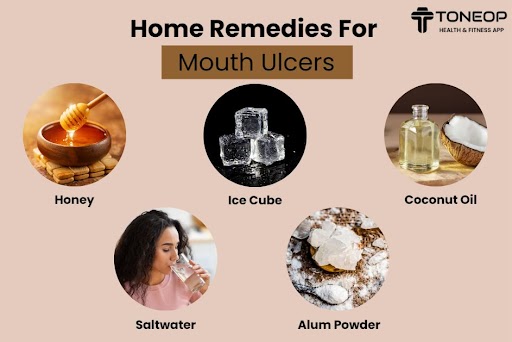 Home Remedies For Mouth Ulcers Picture Box