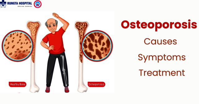 Osteoporosis: Causes, Symptoms, and Treatment Osteoporosis: Causes, Symptoms, and Treatment