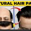 hair patches for men - Picture Box