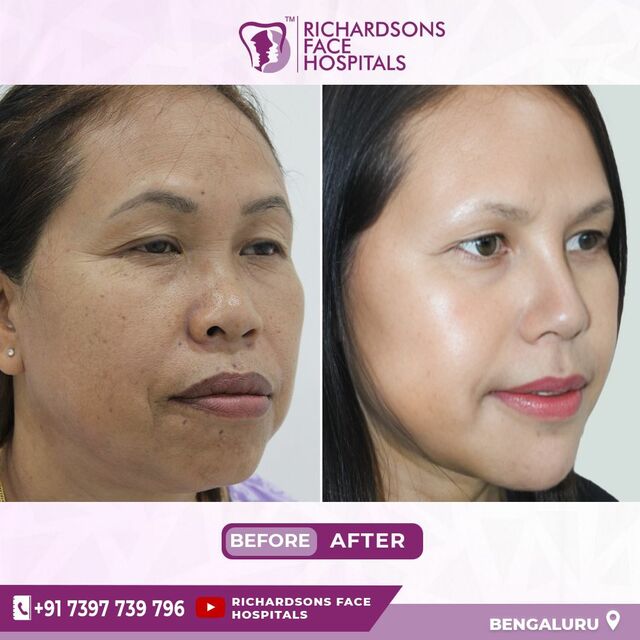 facemakeover1 Best face hospital in India