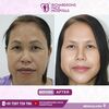 facemakeover2 - Best face hospital in India