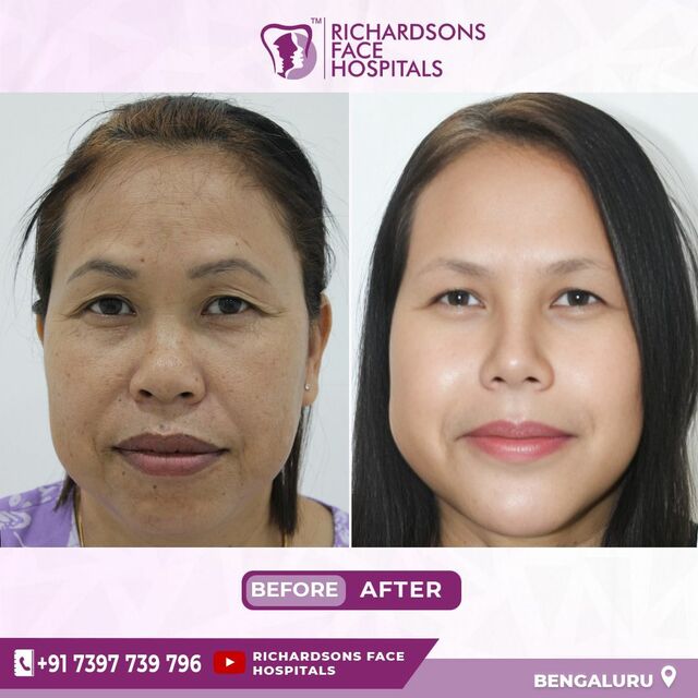 facemakeover2 Best face hospital in India