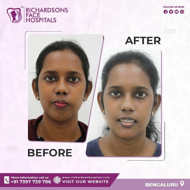 facemakeover3 Best face hospital in India