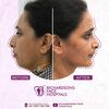 jaw surgery 1 - Best face hospital in India