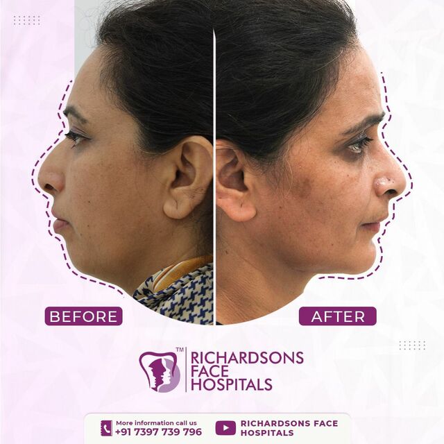 jaw surgery 1 Best face hospital in India