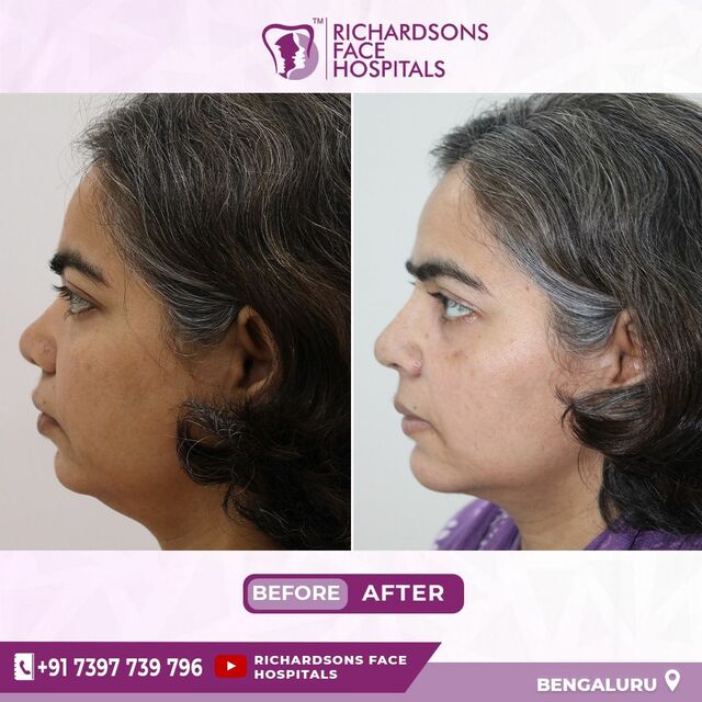 jaw surgery 2 Best face hospital in India