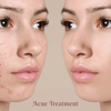 skin-acne-treatments - Picture Box