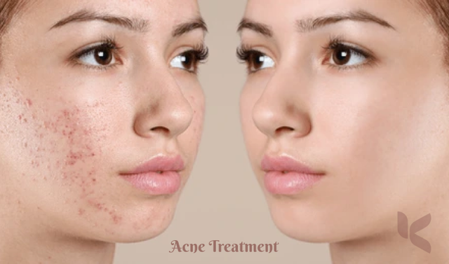 skin-acne-treatments Picture Box