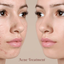 skin-acne-treatments - Picture Box