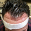 08c9a32c-abb2-4ac8-971c-e4c... - Capital Hair Restoration - Hair Transplant