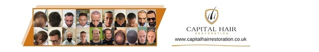 width 1600 Capital Hair Restoration - Hair Transplant