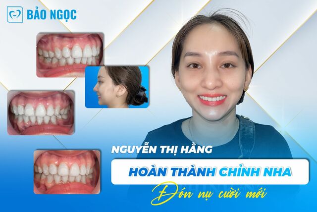 chi-hang-thao-nieng-rang Picture Box