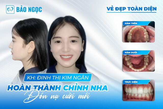 kim-ngan-thao-nieng-rang Picture Box