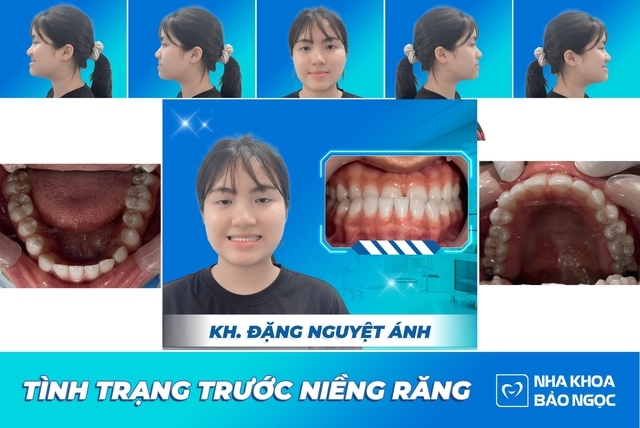 nieng-rang-cho-nguyet-anh Picture Box