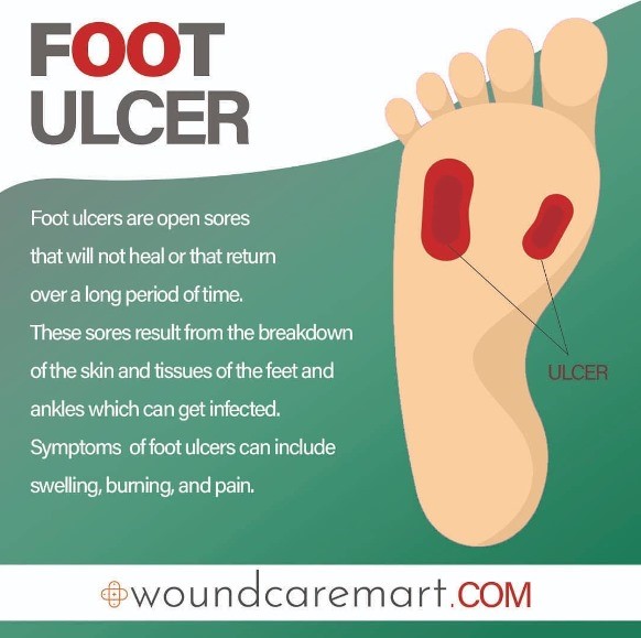 wound3feb woundcaremart
