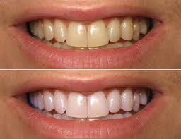 teeth whitening 3 Picture Box