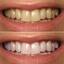 teeth whitening 3 - Picture Box