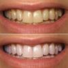 teeth whitening
