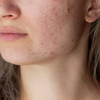 Dermatology in Fargo ND - Skincare Facials Fargo